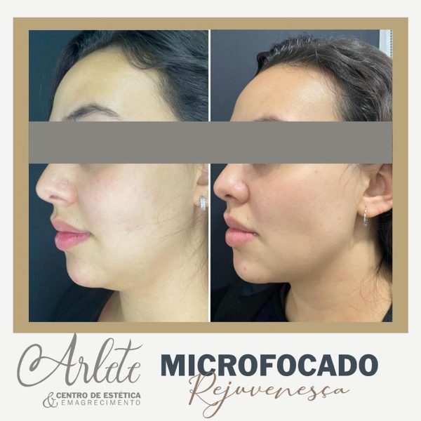 Ultrassom Microfocado Herus Hifu